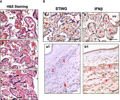 Cell-type specific distribution and activation of type I IFN pathway molecules at the placental maternal-fetal interface in response to COVID-19 infection